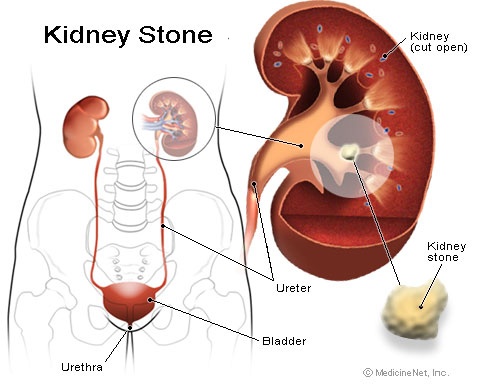 kidney_stone